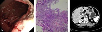 Advanced gastric cancer with metachronous intracranial oligometastases without recurrence after multidisciplinary team discussion and comprehensive treatment: a case report